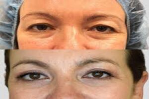 Blefaroplastia Superior: Understanding Upper Eyelid Surgery for Youthful Eyes